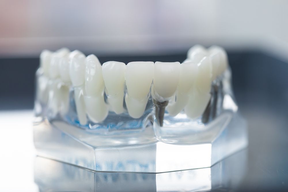Dental Implant Treatment